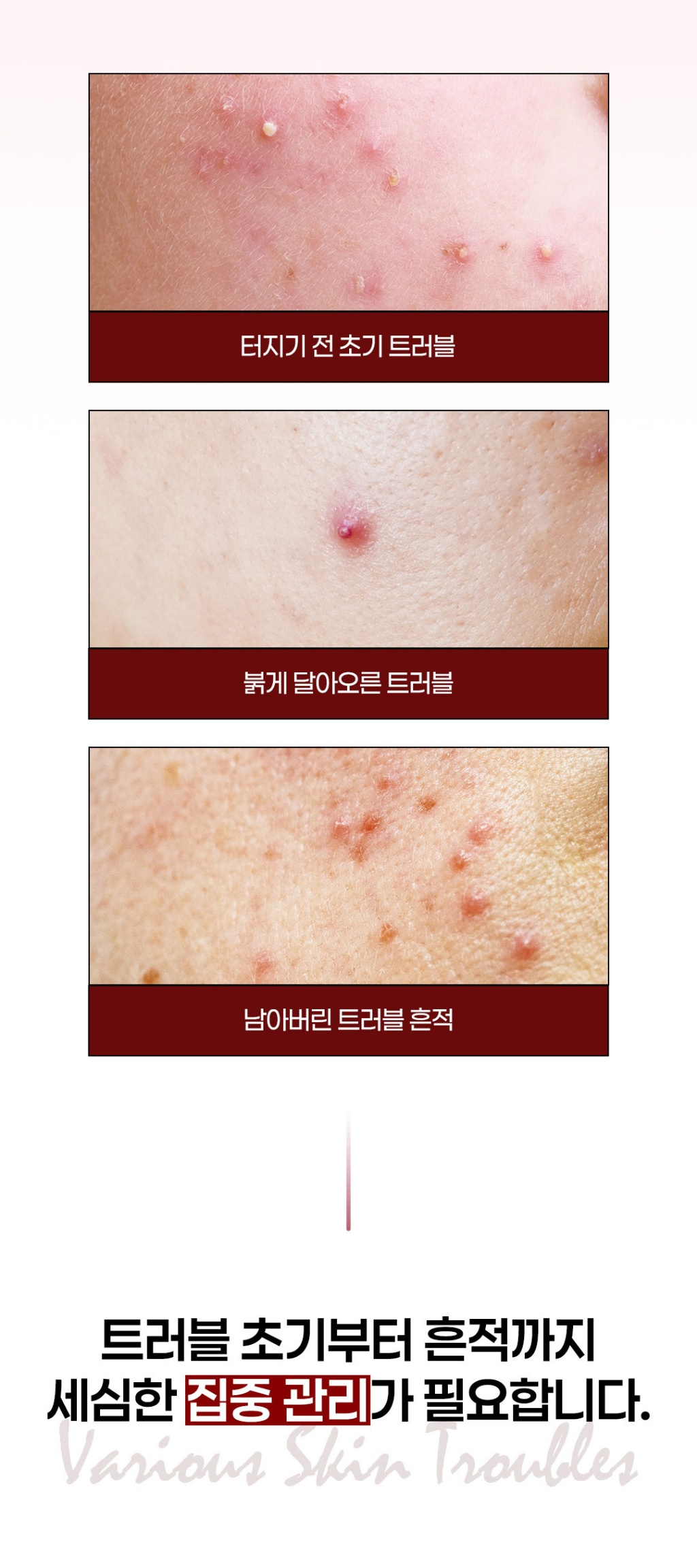 韓國 Wati For Skin 茶樹積雪草痘肌SOS修護凝膠50ml 單瓶 — 圖 9